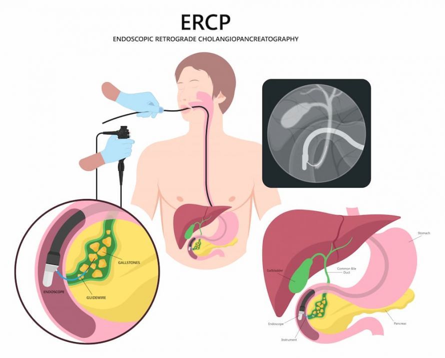 ERCP