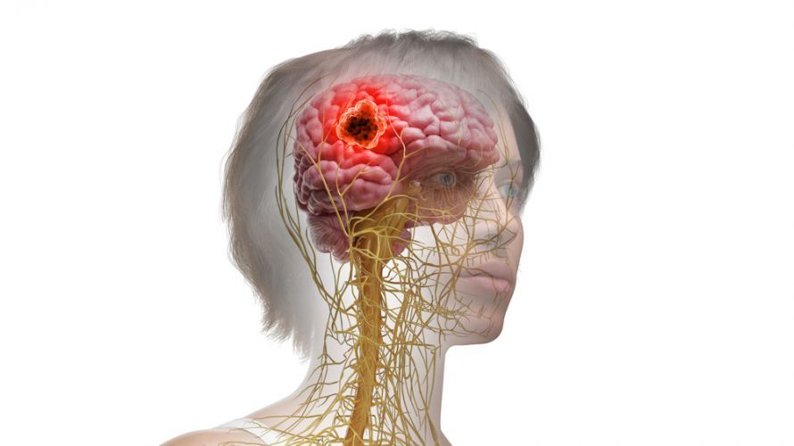 Hirntumor Όγκος στον εγκέφαλο