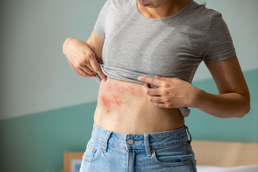 Shingles in People with HIV