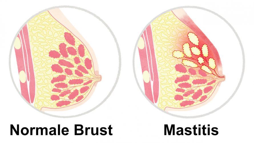 Mastitis Μαστίτιδα
