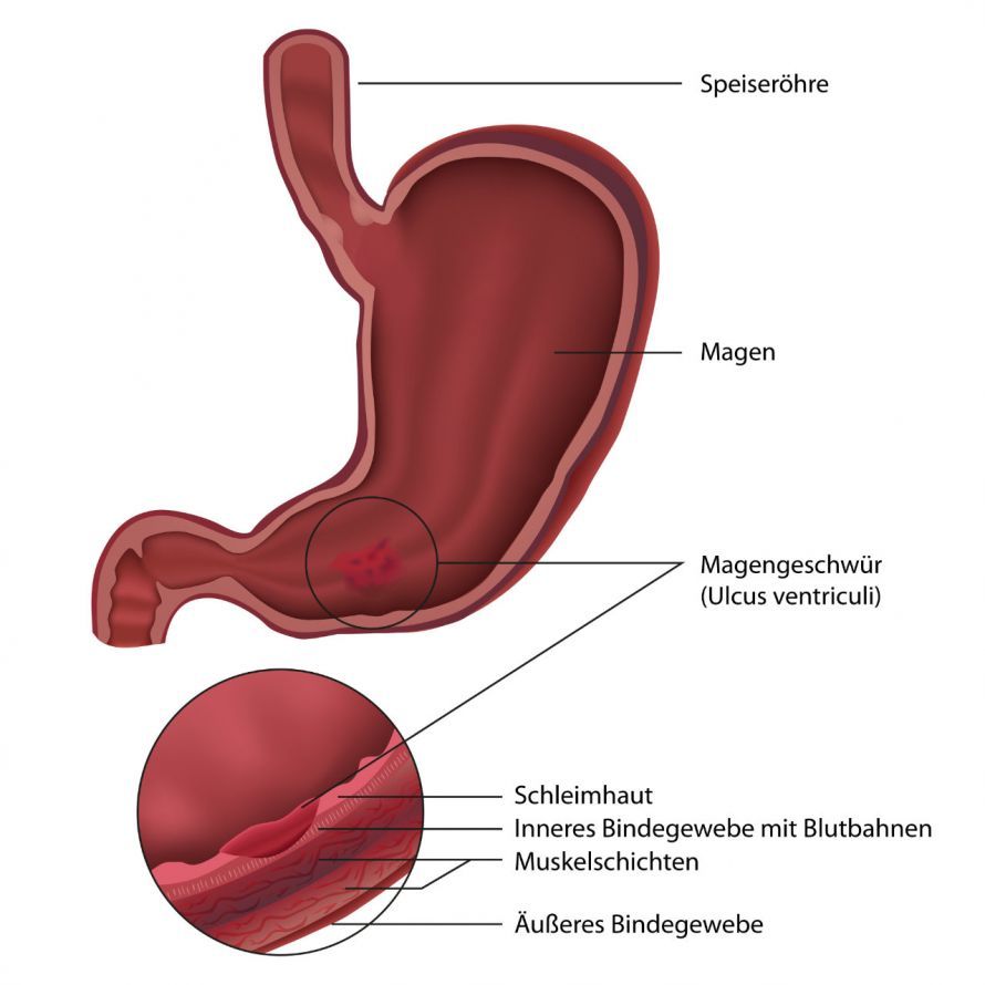 Cross-section of the stomach showing a gastric ulcer