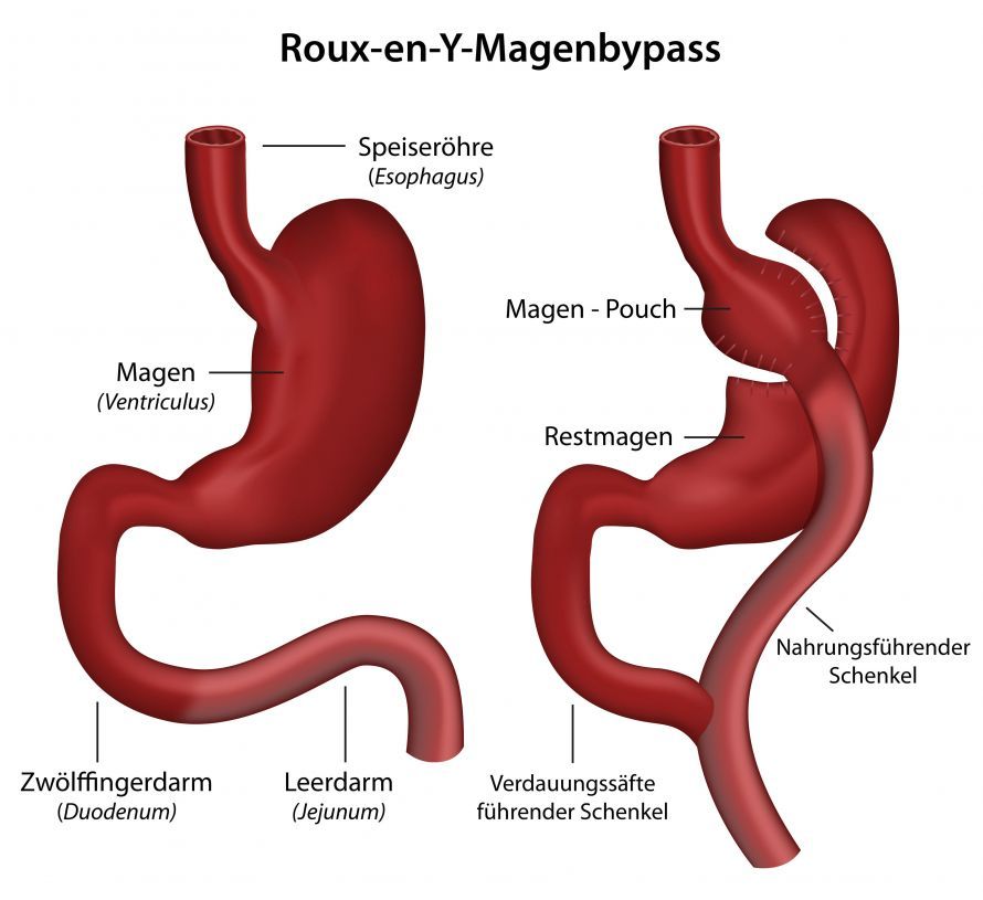Gastrektomie nach Roux-en-Y Gastrektomie nach Roux-en-Y