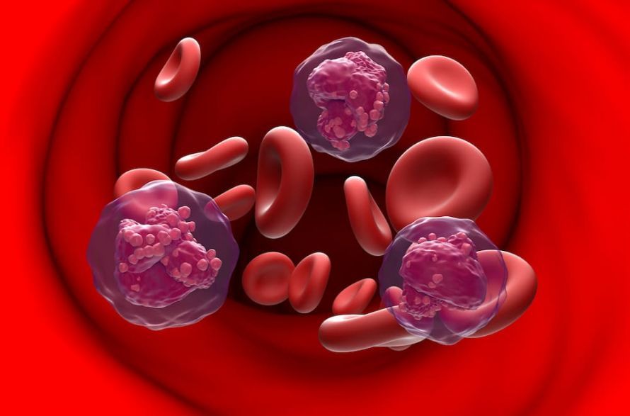 Acute Lymphoblastic Leukemia (ALL)