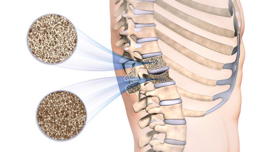 Osteoporose Wirbelsäule Osteoporose Wirbelsäule