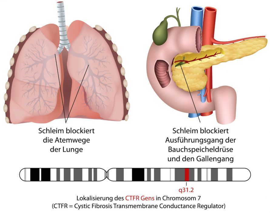 Die Auswirkung von Mukoviszidose auf die Lunge und Gallenwege Die Auswirkung von Mukoviszidose auf die Lunge und Gallenwege