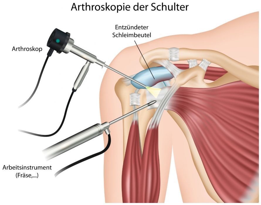 Schulterarthroskopie Schulterarthroskopie