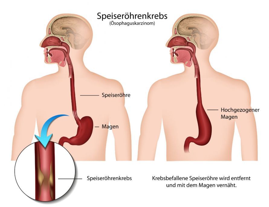 Speiseröhrenkrebs und die Operation von Speiseröhrenkrebs Speiseröhrenkrebs und die Operation von Speiseröhrenkrebs