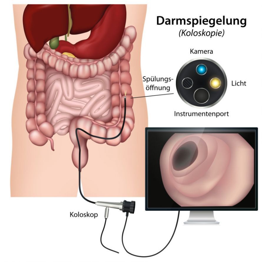 Darmspiegelung Darmspiegelung