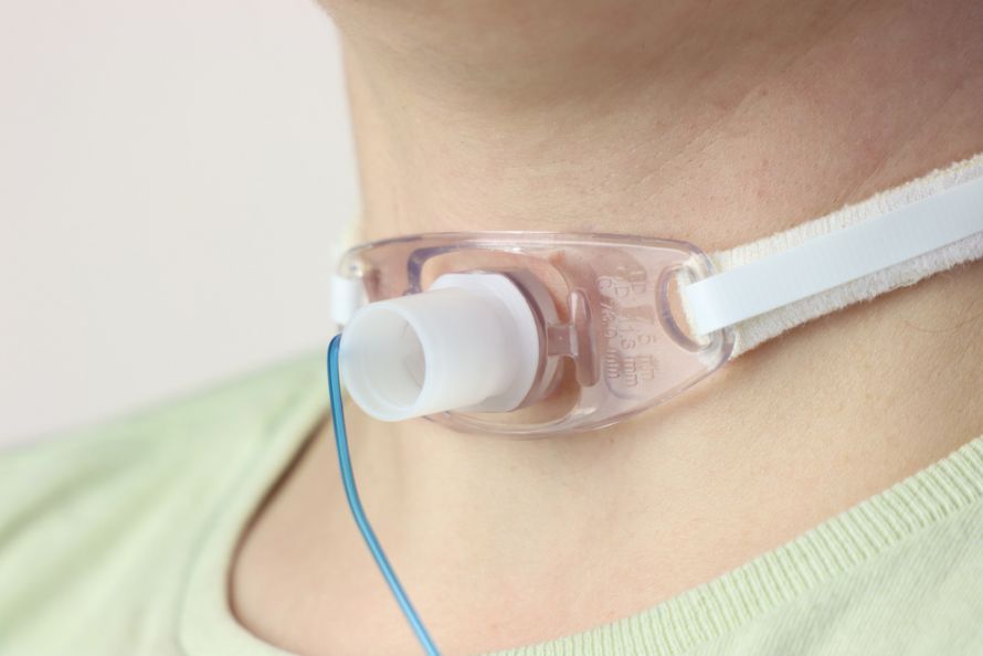 Tracheotomy