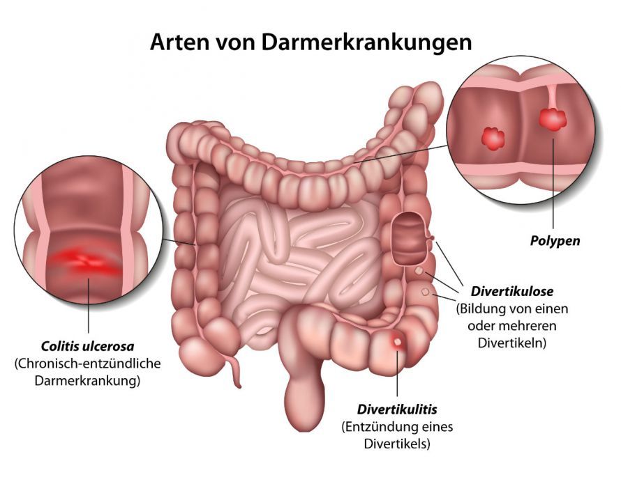 Chronisch-entzündliche Darmerkrankungen Chronisch-entzündliche Darmerkrankungen