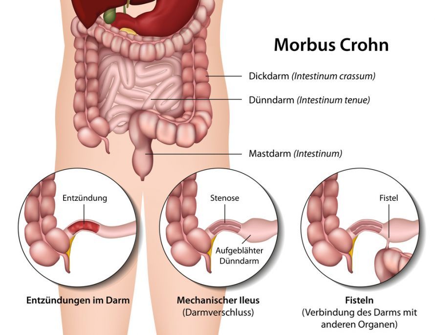 Morbus Crohn Νόσος του Crohn