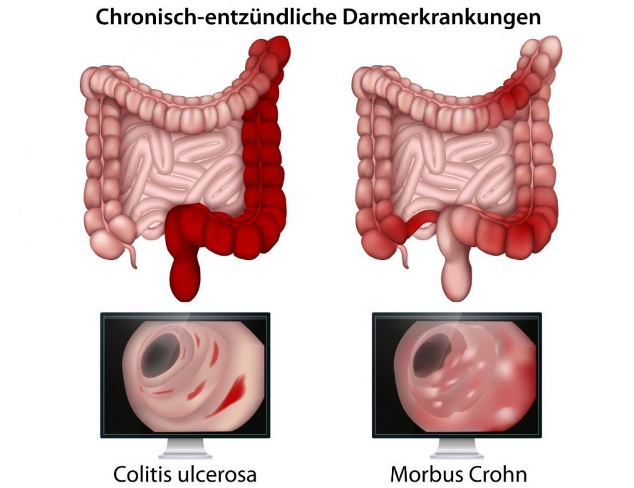 Chronisch-entzündliche Darmerkrankungen Chronic Inflammatory Bowel Diseases