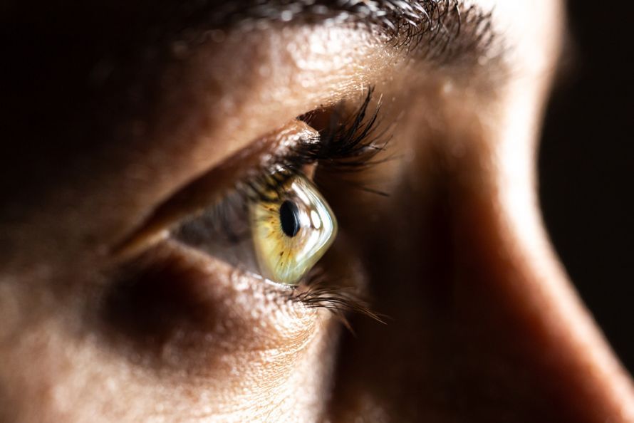 Woman with keratoconus