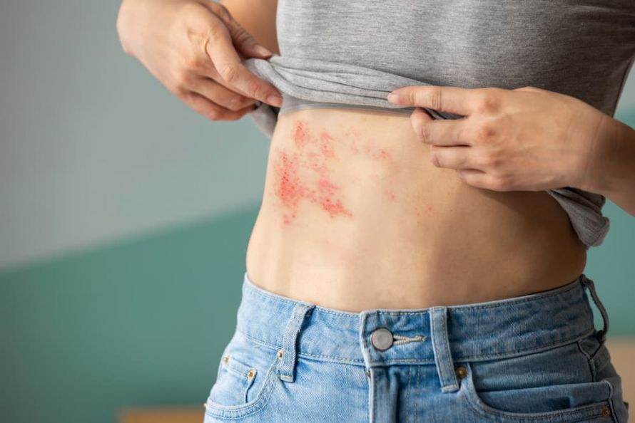 Gürtelrose Shingles