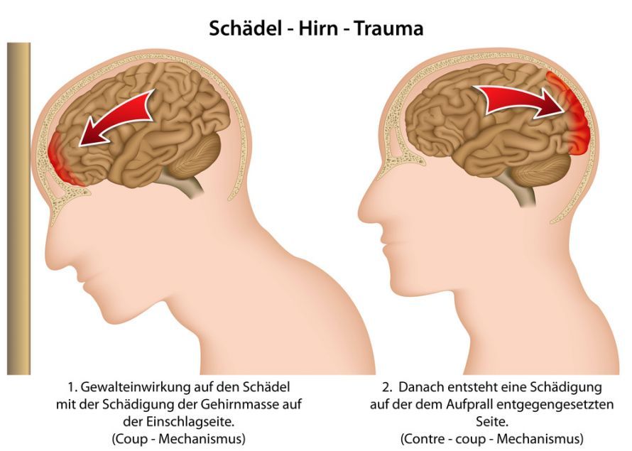 Schädel-Hirn-Trauma Κρανιοεγκεφαλική κάκωση