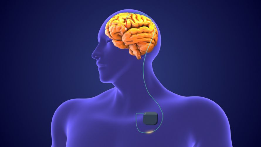 Tiefe Hirnstimulation