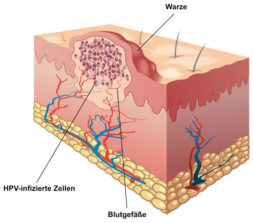 Anatomie von Warzen Ανατομία των κονδυλωμάτων