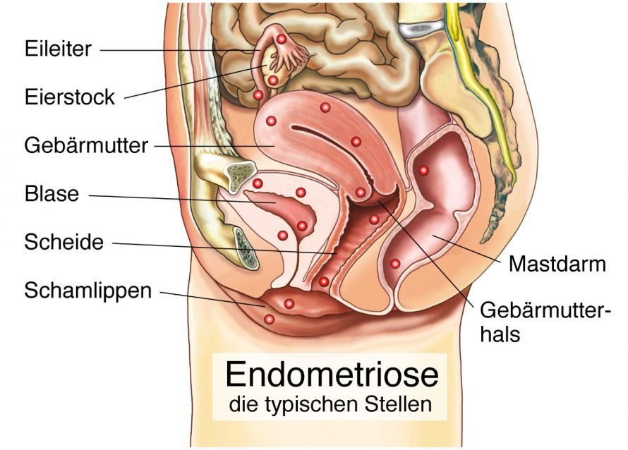 Endometriose Ενδομητρίωση