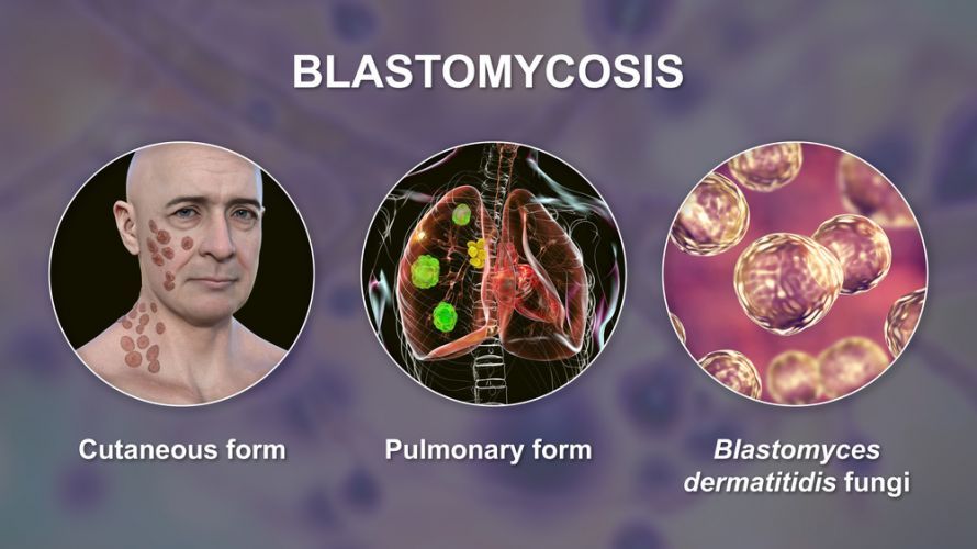 Pulmonary blastomycosis