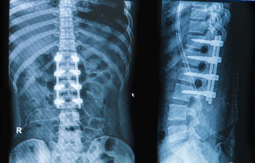 Spondylodese mittels Cage Spondylodese mittels Cage