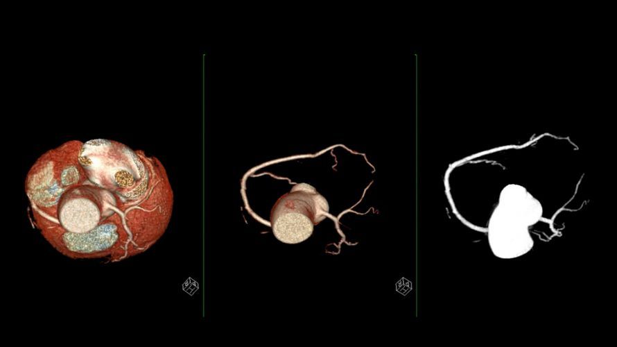 Die 3D-Darstellung der Koronararterien mittels CTA Die 3D-Darstellung der Koronararterien mittels CTA