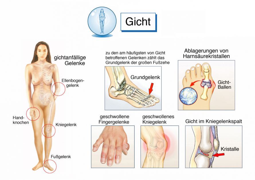 Übersicht über die häufig von Gicht betroffenen Gelenke Επισκόπηση των αρθρώσεων που προσβάλλονται συχνά από ουρική αρθρίτιδα