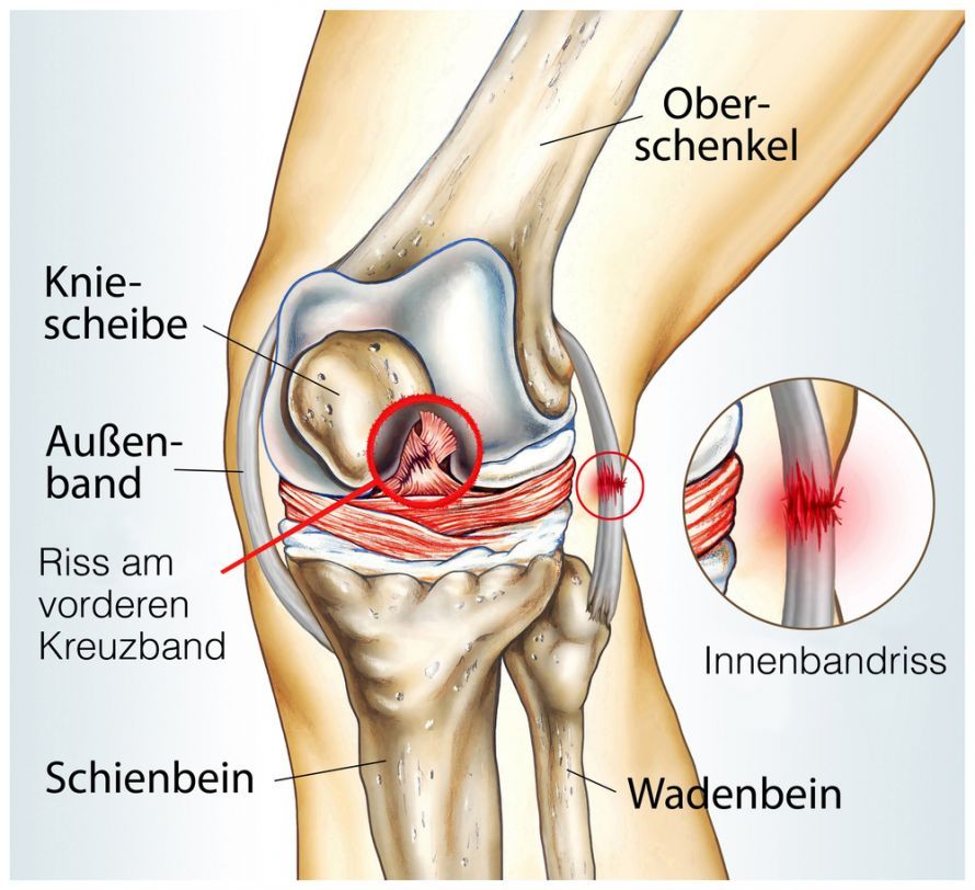Kreuzbandriss Kreuzbandriss