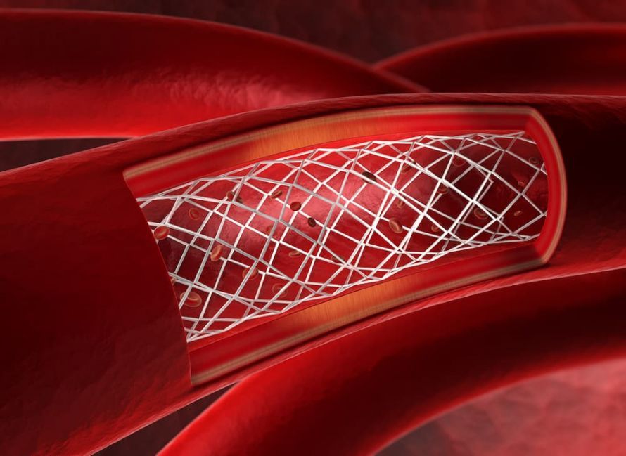 Stent