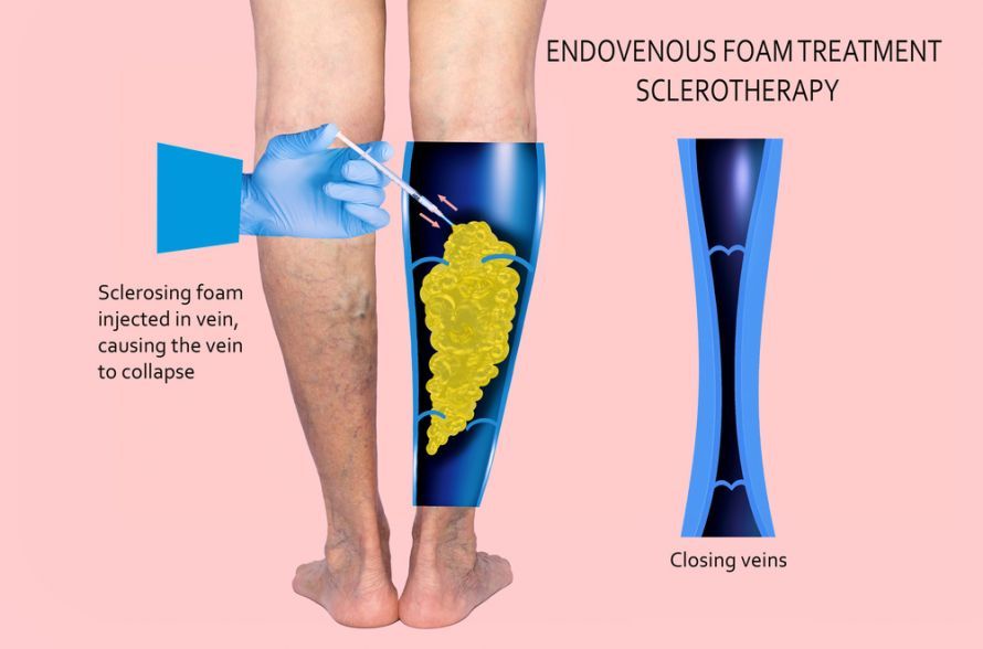 Schaum-Sklerotherapiebehandlung