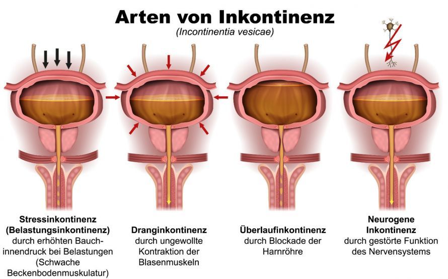 Verschiedene Formen von Harninkontinenz Verschiedene Formen von Harninkontinenz