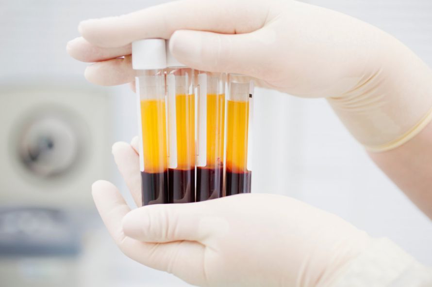 Aus dem Blut herauszentrifugiertes Blutplasma Aus dem Blut herauszentrifugiertes Blutplasma