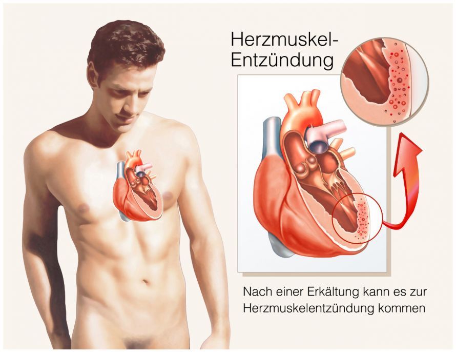 Herzmuskelentzündung