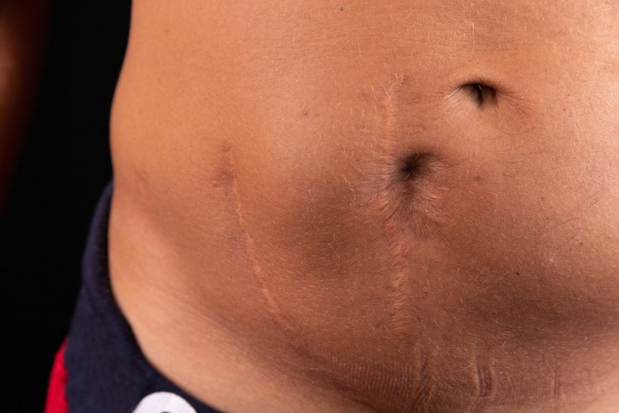 Mann nach Nierentransplantation