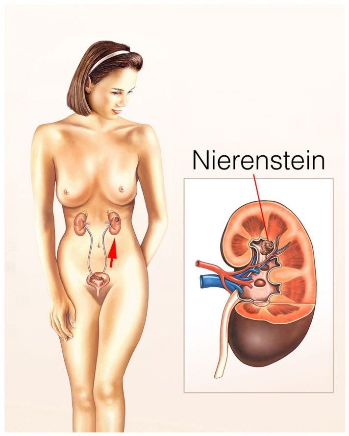 Die Harnwege und die Nieren mit Nierenstein The Urinary Tract and the Kidneys with Kidney Stones