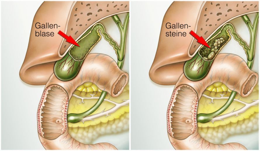 Gallenblase und Gallensteine Gallbladder and Gallstones