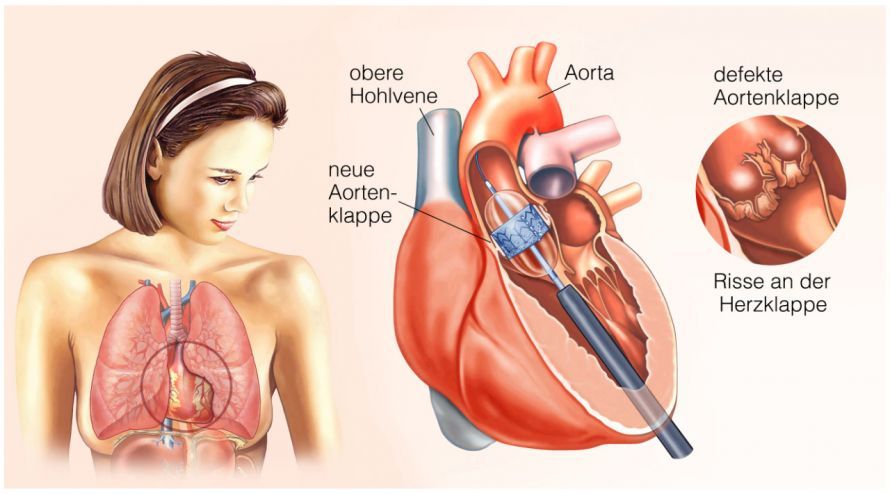 Aortenklappenersatz mittels Katheter Aortic Valve Replacement via Catheter