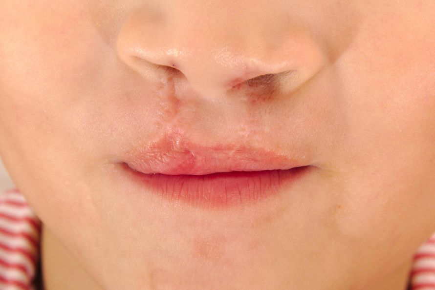 A Successful Treatment for a Cleft Lip and Palate