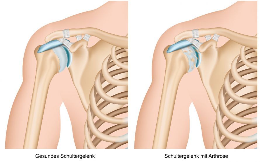 Comparison of a Healthy Shoulder Joint and One with Osteoarthritis