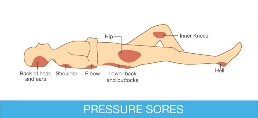 Dekubitus Pressure Ulcers