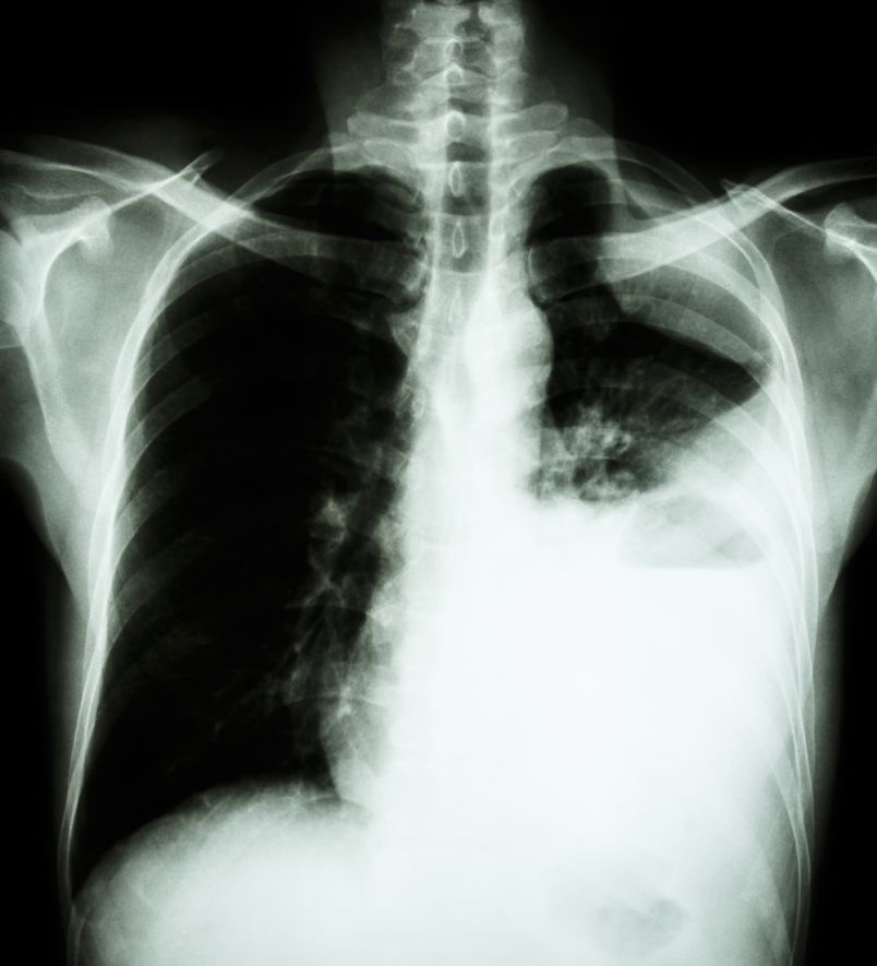 Pleural carcinomatosis