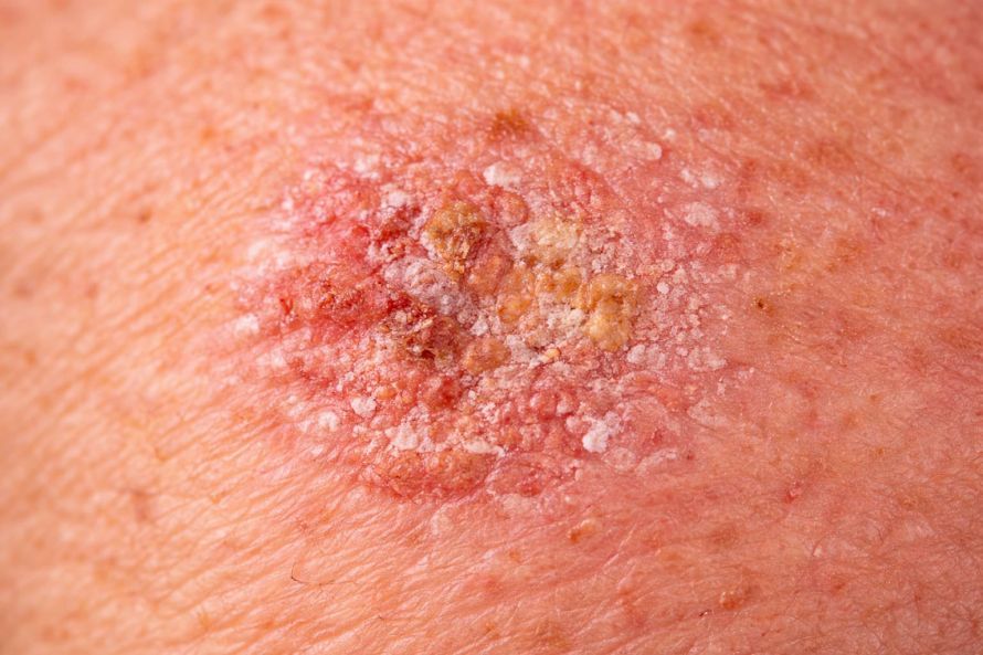 Aktinische Keratose auf sonnenbeschädigter Haut Aktinische Keratose auf sonnenbeschädigter Haut