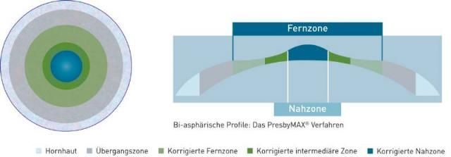 Alterssichtigkeitskorrektur
