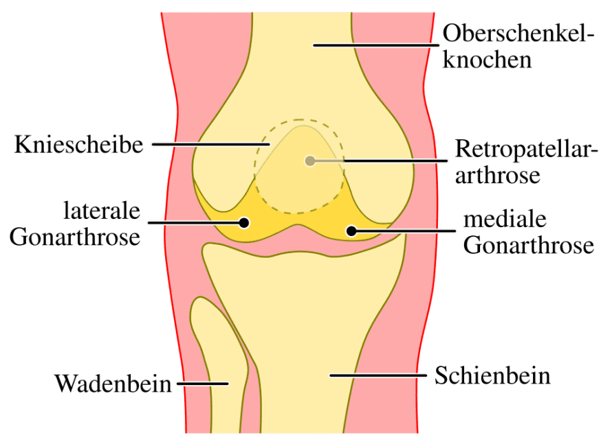 Arthrose Knie._Stündle, CC0, via Wikimedia Commons Arthrose Knie._Stündle, CC0, via Wikimedia Commons