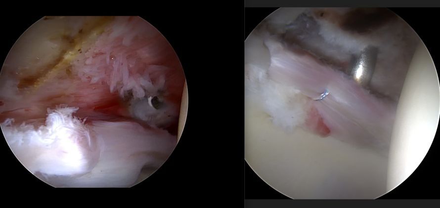 Foto Arthroskopiebild links mit Labrumriss rechts nach Refixation mit Ankern Foto Arthroskopiebild links mit Labrumriss rechts nach Refixation mit Ankern