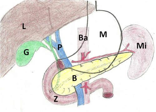Bauchspeicheldrüsenkrebs-OP1