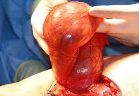 Bauchwandhernien-OP Bauchwandhernien-OP