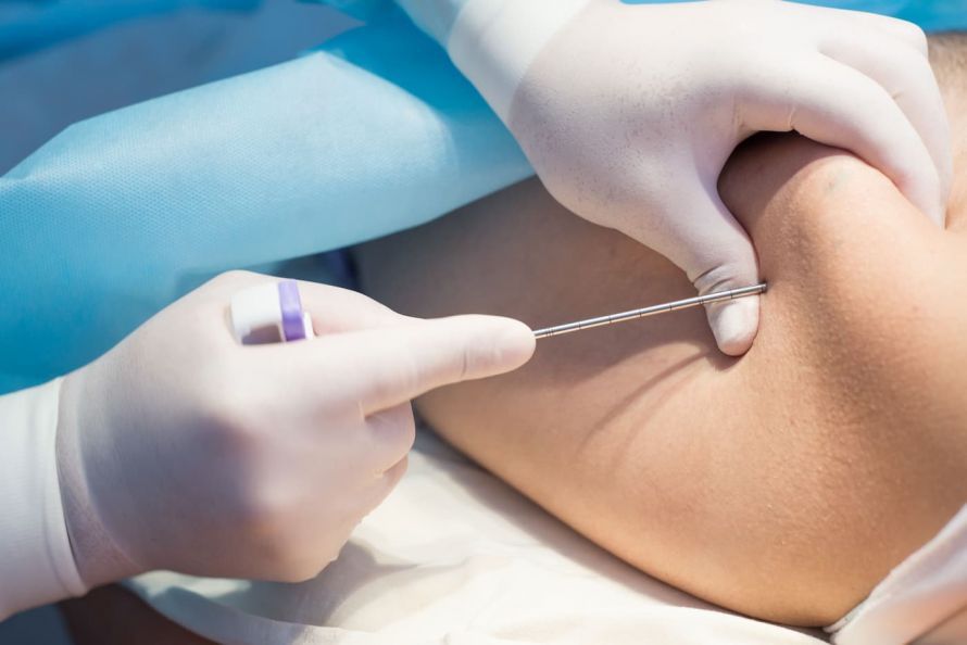 Biopsie aus Knochen Bone biopsy