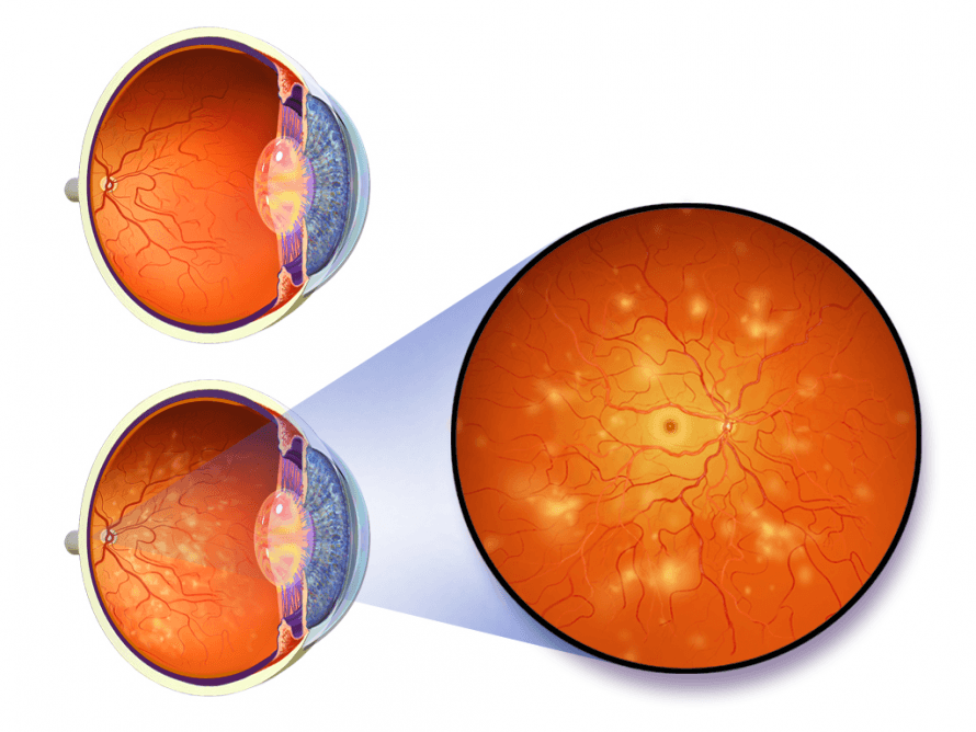 Blausen 0312 DiabeticRetinopathy Blausen 0312 DiabeticRetinopathy
