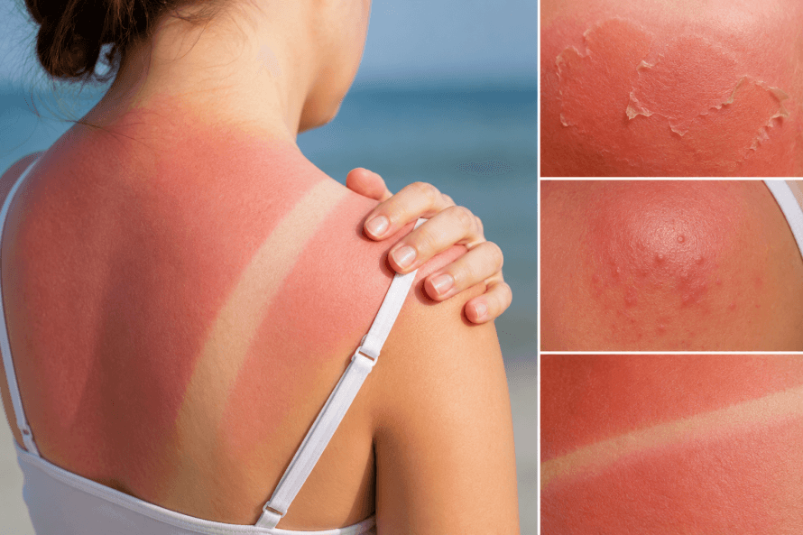 sonnenbrand sonnenbrand