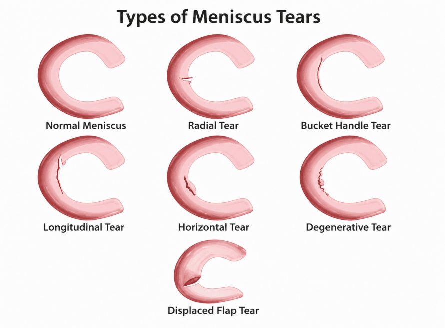 Meniskusrisse englisch